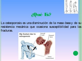 ¿Qué Es?
La osteoporosis es una disminución de la masa ósea y de su
resistencia mecánica que ocasiona susceptibilidad para las
fracturas.
 