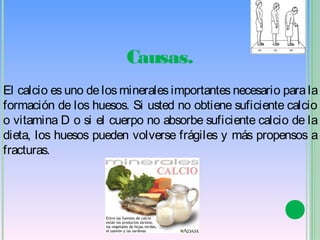 Causas.
El calcio es uno de los minerales importantes necesario para la
formación de los huesos. Si usted no obtiene suficiente calcio
o vitamina D o si el cuerpo no absorbe suficiente calcio de la
dieta, los huesos pueden volverse frágiles y más propensos a
fracturas. 
 