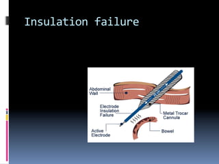 Lap anatomy and complications2012 | PDF