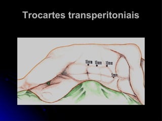 Trocartes transperitoniais 