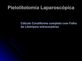 Pielolitotomia Laparoscópica Cálculo Coraliforme completo com Falha da Litotripsia extracorpórea  