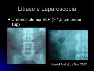 Ureterolitotomia VLP (> 1,5 cm ureter sup)   Hemal A et al.,  J Urol 2003 Litíase e Laparoscopia 