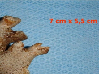 Lingeman JE; Surgical management of urinary lithiasis .  In Campbell´s Urology. 8 ed. 2002 7 cm x 5,5 cm 