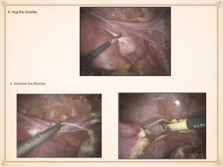 4. Hug the Ovaries
5. Mobilize the Bladder
 