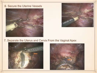 6. Secure the Uterine Vessels
7. Separate the Uterus and Cervix From the Vaginal Apex
 