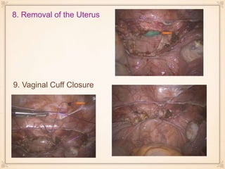 8. Removal of the Uterus
9. Vaginal Cuff Closure
 