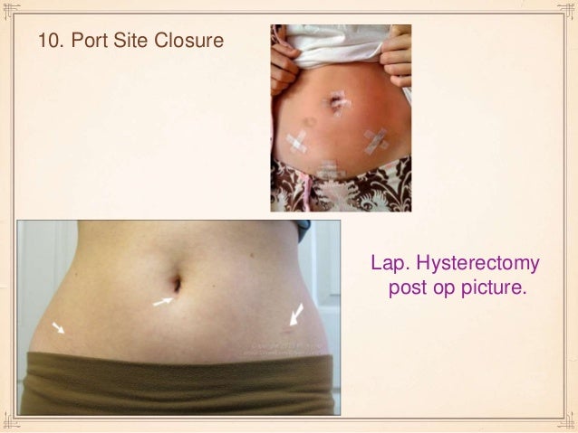 Lap hysterectomy artical