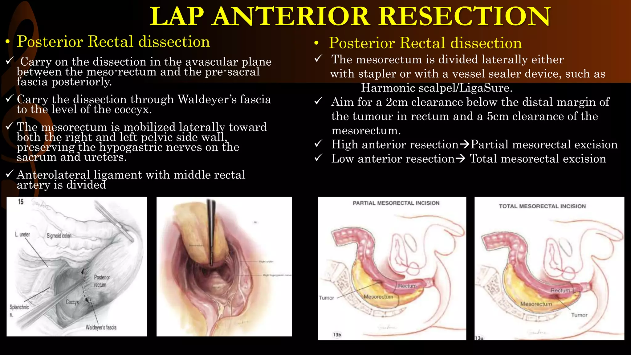 • Posterior Rectal dissection
 Carry on the dissection in the avascular plane
between the meso-rectum and the pre-sacral
fascia posteriorly.
 Carry the dissection through Waldeyer’s fascia
to the level of the coccyx.
 The mesorectum is mobilized laterally toward
both the right and left pelvic side wall,
preserving the hypogastric nerves on the
sacrum and ureters.
 Anterolateral ligament with middle rectal
artery is divided
• Posterior Rectal dissection
 The mesorectum is divided laterally either
with stapler or with a vessel sealer device, such as
Harmonic scalpel/LigaSure.
 Aim for a 2cm clearance below the distal margin of
the tumour in rectum and a 5cm clearance of the
mesorectum.
 High anterior resectionPartial mesorectal excision
 Low anterior resection Total mesorectal excision
LAP ANTERIOR RESECTION
 
