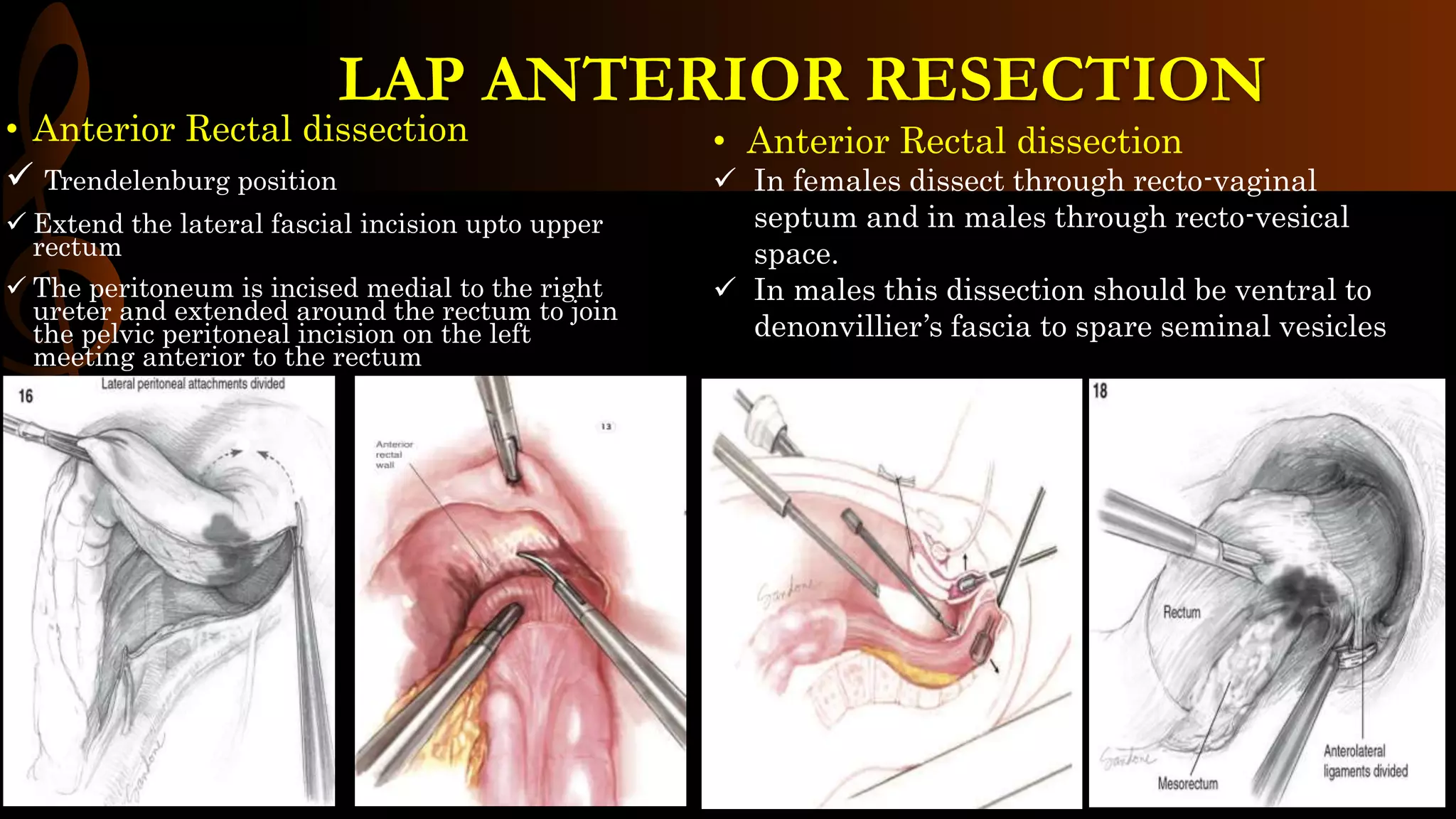 • Anterior Rectal dissection
 Trendelenburg position
 Extend the lateral fascial incision upto upper
rectum
 The peritoneum is incised medial to the right
ureter and extended around the rectum to join
the pelvic peritoneal incision on the left
meeting anterior to the rectum
• Anterior Rectal dissection
 In females dissect through recto-vaginal
septum and in males through recto-vesical
space.
 In males this dissection should be ventral to
denonvillier’s fascia to spare seminal vesicles
LAP ANTERIOR RESECTION
 