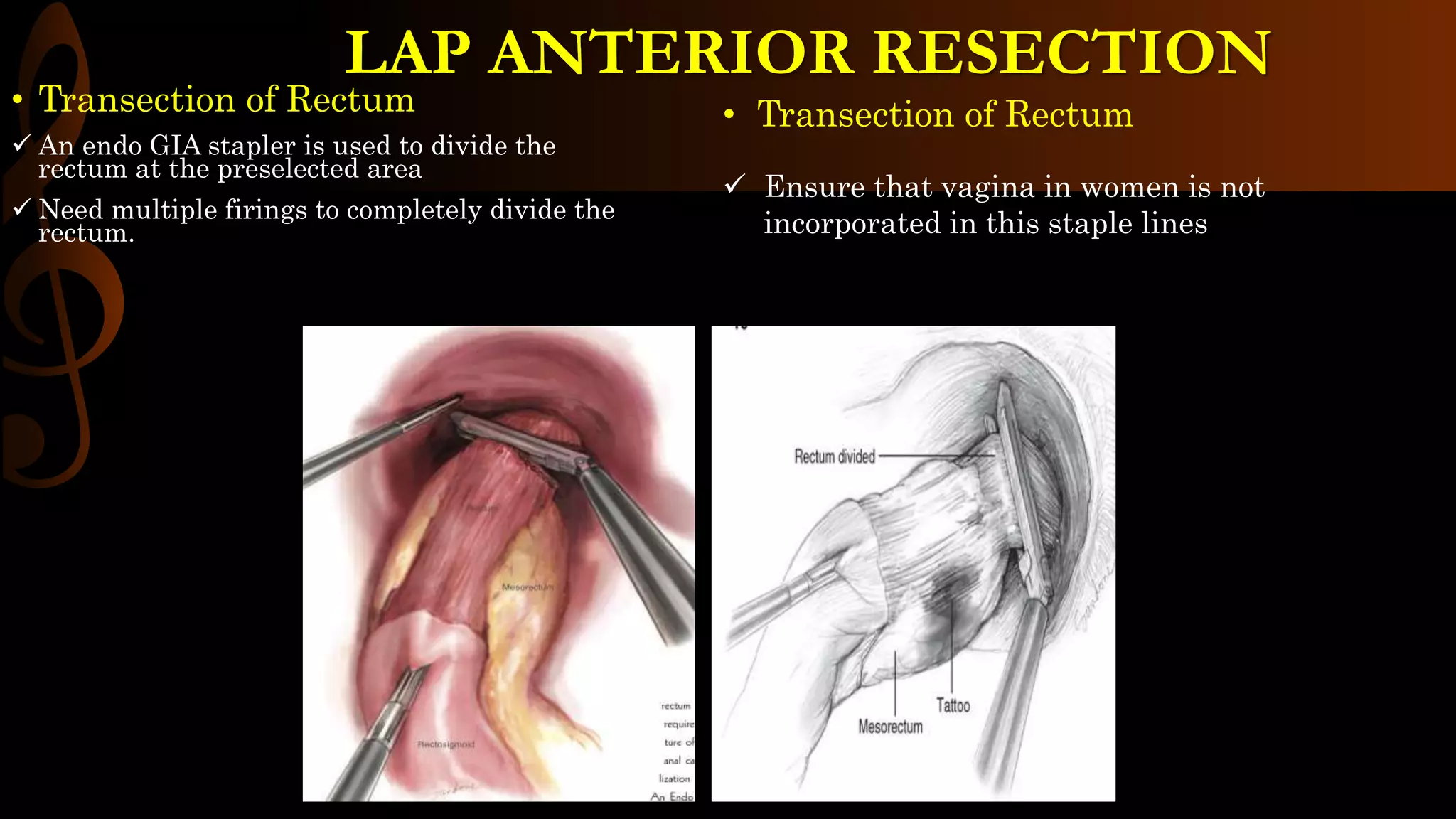• Transection of Rectum
 An endo GIA stapler is used to divide the
rectum at the preselected area
 Need multiple firings to completely divide the
rectum.
• Transection of Rectum
 Ensure that vagina in women is not
incorporated in this staple lines
LAP ANTERIOR RESECTION
 
