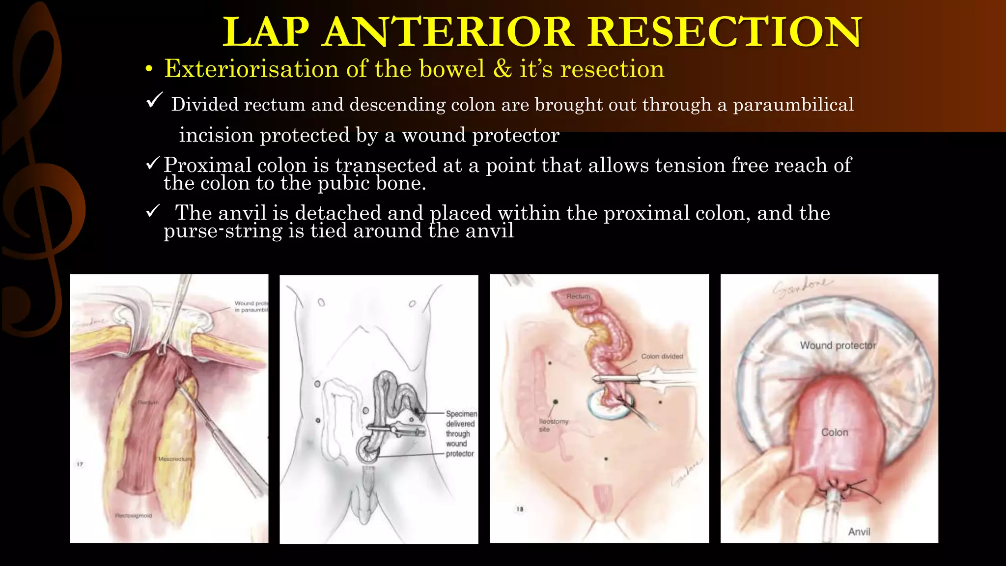 • Exteriorisation of the bowel & it’s resection
 Divided rectum and descending colon are brought out through a paraumbilical
incision protected by a wound protector
Proximal colon is transected at a point that allows tension free reach of
the colon to the pubic bone.
 The anvil is detached and placed within the proximal colon, and the
purse-string is tied around the anvil
LAP ANTERIOR RESECTION
 