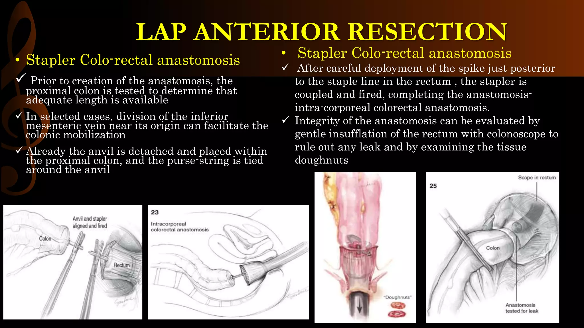 • Stapler Colo-rectal anastomosis
 Prior to creation of the anastomosis, the
proximal colon is tested to determine that
adequate length is available
 In selected cases, division of the inferior
mesenteric vein near its origin can facilitate the
colonic mobilization
 Already the anvil is detached and placed within
the proximal colon, and the purse-string is tied
around the anvil
LAP ANTERIOR RESECTION
• Stapler Colo-rectal anastomosis
 After careful deployment of the spike just posterior
to the staple line in the rectum , the stapler is
coupled and fired, completing the anastomosis-
intra-corporeal colorectal anastomosis.
 Integrity of the anastomosis can be evaluated by
gentle insufflation of the rectum with colonoscope to
rule out any leak and by examining the tissue
doughnuts
 