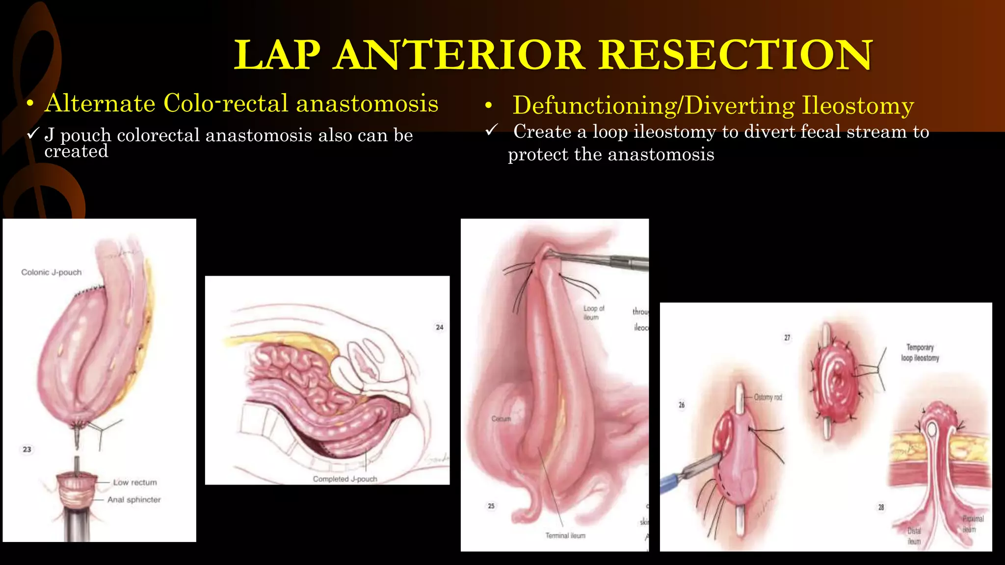 • Alternate Colo-rectal anastomosis
 J pouch colorectal anastomosis also can be
created
LAP ANTERIOR RESECTION
• Defunctioning/Diverting Ileostomy
 Create a loop ileostomy to divert fecal stream to
protect the anastomosis
 