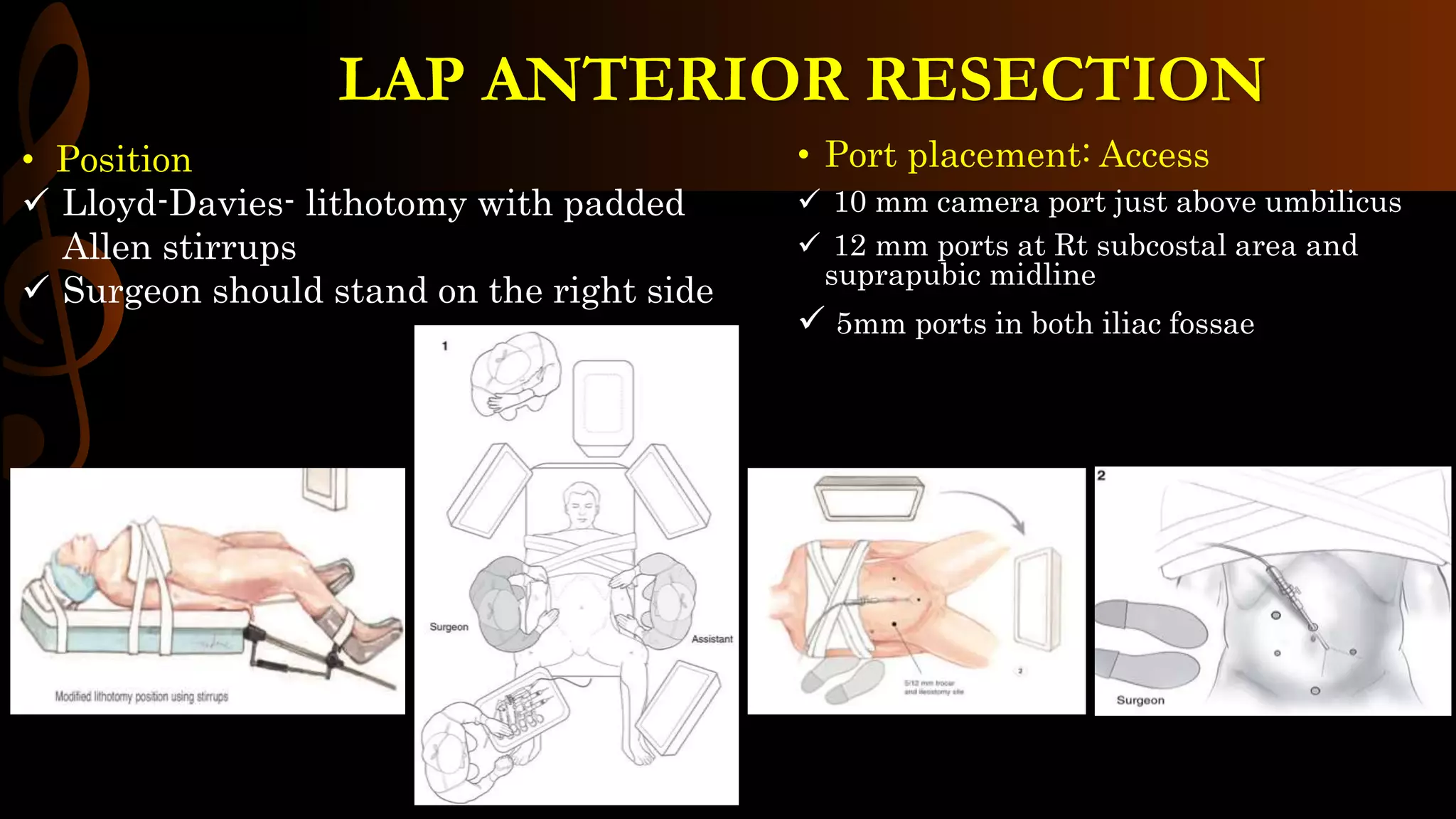 LAP ANTERIOR RESECTION STEP BY STEP Operative Surgery pptx