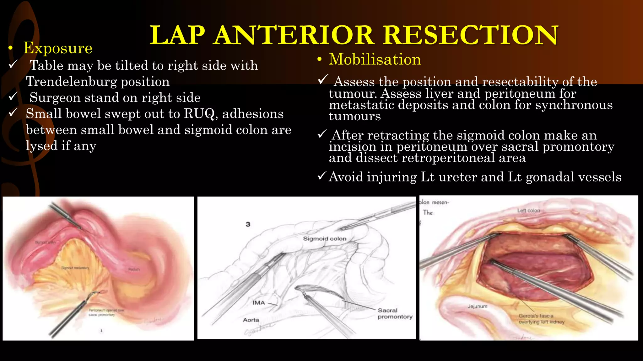 • Mobilisation
 Assess the position and resectability of the
tumour. Assess liver and peritoneum for
metastatic deposits and colon for synchronous
tumours
 After retracting the sigmoid colon make an
incision in peritoneum over sacral promontory
and dissect retroperitoneal area
Avoid injuring Lt ureter and Lt gonadal vessels
• Exposure
 Table may be tilted to right side with
Trendelenburg position
 Surgeon stand on right side
 Small bowel swept out to RUQ, adhesions
between small bowel and sigmoid colon are
lysed if any
LAP ANTERIOR RESECTION
 