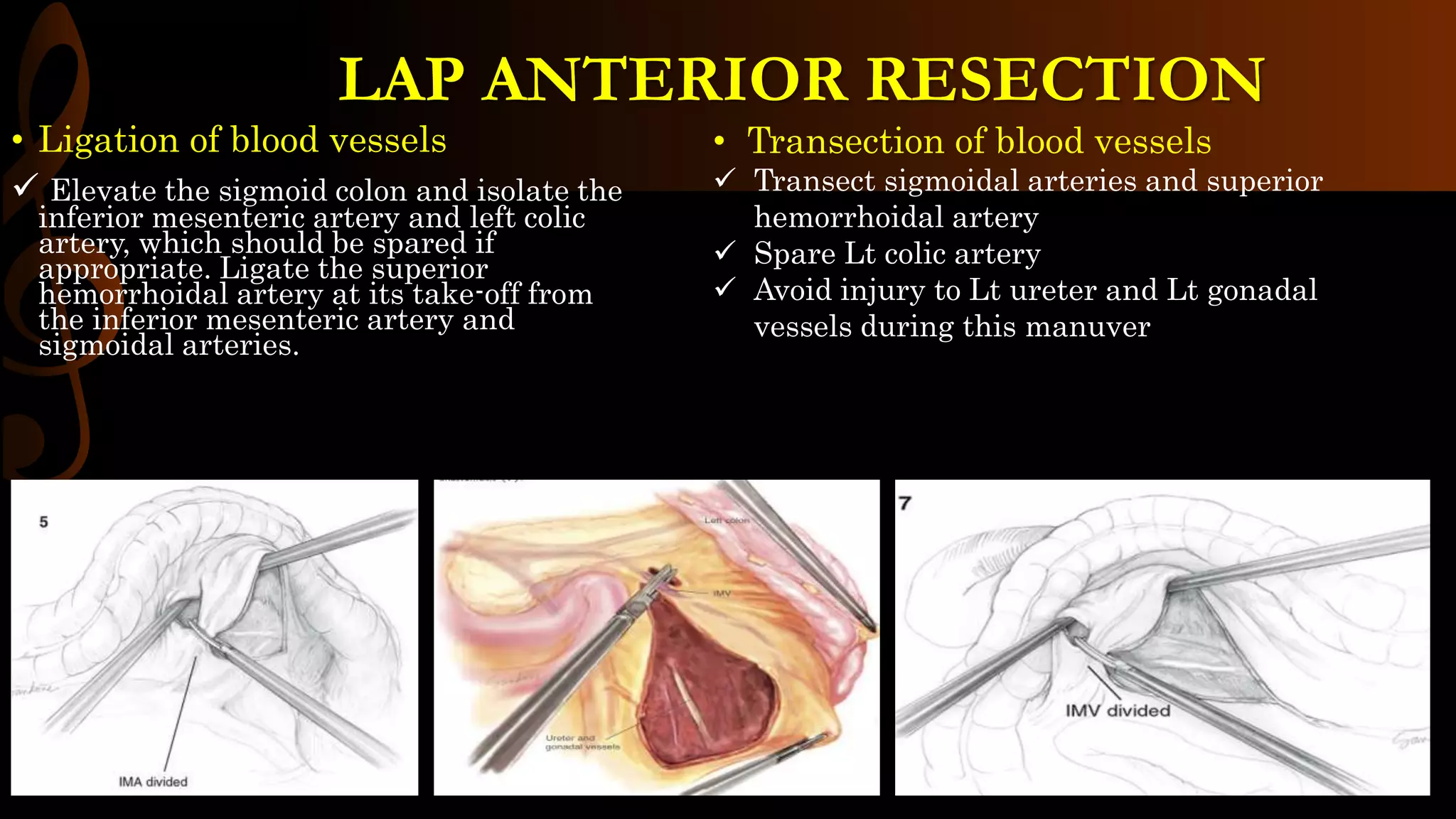 • Ligation of blood vessels
 Elevate the sigmoid colon and isolate the
inferior mesenteric artery and left colic
artery, which should be spared if
appropriate. Ligate the superior
hemorrhoidal artery at its take-off from
the inferior mesenteric artery and
sigmoidal arteries.
• Transection of blood vessels
 Transect sigmoidal arteries and superior
hemorrhoidal artery
 Spare Lt colic artery
 Avoid injury to Lt ureter and Lt gonadal
vessels during this manuver
LAP ANTERIOR RESECTION
 