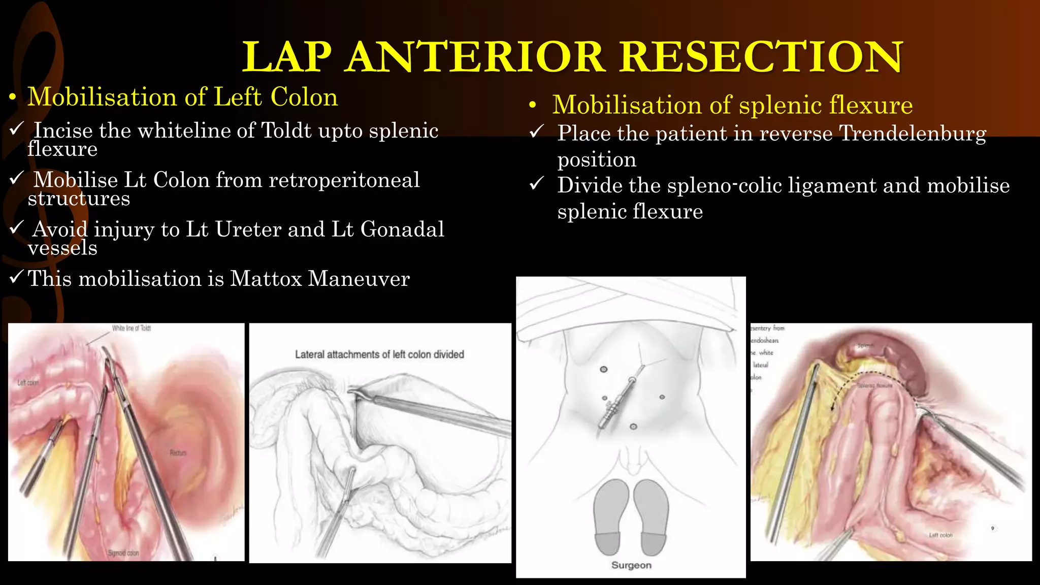 • Mobilisation of Left Colon
 Incise the whiteline of Toldt upto splenic
flexure
 Mobilise Lt Colon from retroperitoneal
structures
 Avoid injury to Lt Ureter and Lt Gonadal
vessels
This mobilisation is Mattox Maneuver
• Mobilisation of splenic flexure
 Place the patient in reverse Trendelenburg
position
 Divide the spleno-colic ligament and mobilise
splenic flexure
LAP ANTERIOR RESECTION
 