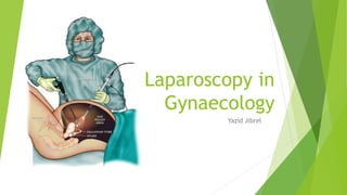 Laparoscopy in
Gynaecology
Yazid Jibrel
 