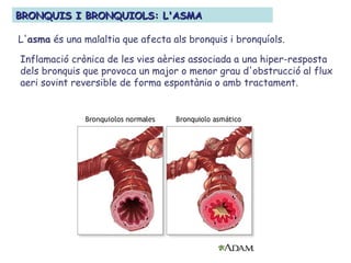 Inflamació crònica de les vies aèries associada a una hiper-resposta
dels bronquis que provoca un major o menor grau d'obstrucció al flux
aeri sovint reversible de forma espontània o amb tractament.
BRONQUIS I BRONQUIOLS: L'ASMABRONQUIS I BRONQUIOLS: L'ASMA
L'asma és una malaltia que afecta als bronquis i bronquíols.
 