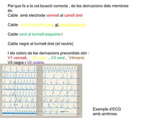 Pel que fa a la col.locació correcta , de les derivacions dels membres és: Cable  amb electrode  vermell  al  canell dret Cable   amb electrode  groc  al  canell esquerre Cable  verd al turmell esquerre  i Cable negre al turmell dret (el neutre) I els colors de les derivacions precordials són : V1 vermell ,  V2  groc  ,  V3 verd  ,  V4marró   V5 negre i  V6 violeta Exemple d’ECG amb arrítmies 