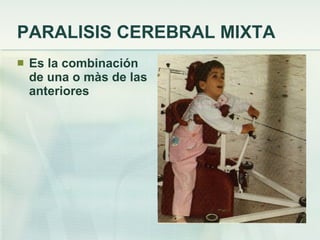 PARALISIS CEREBRAL MIXTA Es la combinación de una o màs de las anteriores 