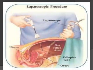 Laparoscopia