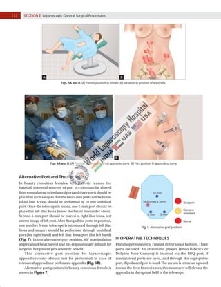 Laparoscopic Appendicectomy at World Laparoscopy Hospital | PDF