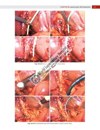 203
CHAPTER 14: Laparoscopic CBD Exploration
A
C
B
D
Figs. 5A to D: Fogarty catheter used to extract stone.
A
C
B
D
Figs. 6A to D: Choledochoscope with Dormia basket is used to extract stone.
 