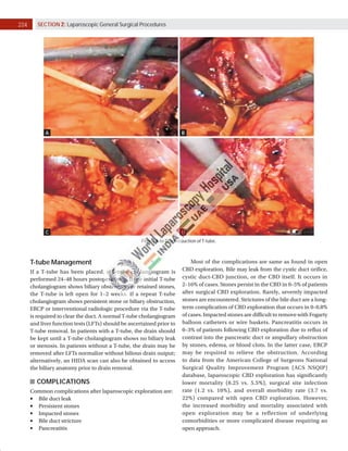 204 SECTION 2: Laparoscopic General Surgical Procedures
C
A
D
B
Figs. 7A to D: Introduction of T-tube.
T-tube Management
If a T-tube has been placed, a T-tube cholangiogram is
performed 24–48 hours postoperatively. If the initial T-tube
cholangiogram shows biliary obstruction or retained stones,
the T-tube is left open for 1–2 weeks. If a repeat T-tube
cholangiogram shows persistent stone or biliary obstruction,
ERCP or interventional radiologic procedure via the T-tube
is required to clear the duct. A normal T-tube cholangiogram
and liver function tests (LFTs) should be ascertained prior to
T-tube removal. In patients with a T-tube, the drain should
be kept until a T-tube cholangiogram shows no biliary leak
or stenosis. In patients without a T-tube, the drain may be
removed after LFTs normalize without bilious drain output;
alternatively, an HIDA scan can also be obtained to access
the biliary anatomy prior to drain removal.
COMPLICATIONS
Common complications after laparoscopic exploration are:
	
■ Bile duct leak
	
■ Persistent stones
	
■ Impacted stones
	
■ Bile duct stricture
	
■ Pancreatitis
Most of the complications are same as found in open
CBD exploration. Bile may leak from the cystic duct orifice,
cystic duct-CBD junction, or the CBD itself. It occurs in
2–16% of cases. Stones persist in the CBD in 0–5% of patients
after surgical CBD exploration. Rarely, severely impacted
stones are encountered. Strictures of the bile duct are a long-
term complication of CBD exploration that occurs in 0–0.8%
of cases. Impacted stones are difficult to remove with Fogarty
balloon catheters or wire baskets. Pancreatitis occurs in
0–3% of patients following CBD exploration due to reflux of
contrast into the pancreatic duct or ampullary obstruction
by stones, edema, or blood clots. In the latter case, ERCP
may be required to relieve the obstruction. According
to data from the American College of Surgeons National
Surgical Quality Improvement Program (ACS NSQIP)
database, laparoscopic CBD exploration has significantly
lower mortality (0.25 vs. 5.5%), surgical site infection
rate (1.2 vs. 10%), and overall morbidity rate (3.7 vs.
22%) compared with open CBD exploration. However,
the increased morbidity and mortality associated with
open exploration may be a reflection of underlying
comorbidities or more complicated disease requiring an
open approach.
 