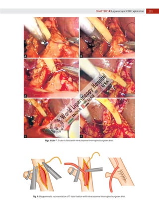 205
CHAPTER 14: Laparoscopic CBD Exploration
A
C
E
B
D
F
Figs. 8A to F: T-tube is fixed with intracorporeal interrupted surgeons knot.
Fig. 9: Diagrammatic representation of T-tube fixation with intracorporeal interrupted surgeons knot.
 