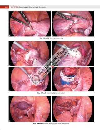 440 SECTION 3: Laparoscopic Gynecological Procedures
Figs. 19A and B: Securing uterine artery.
Figs. 20A to D: Colpotomy by harmonic scalpel.
Figs. 21A and B: Removal of uterus through the vaginal route.
A B
A B
C D
A B
 