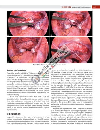 441
CHAPTER 34: Laparoscopic Hysterectomy
Figs. 22A to D: Vault closure with by continuous suturing.
Ending the Procedure
One of the benefits of LAVH or TLH over nondescent vaginal
hysterectomy (NDVH) is inspection of pedicles at the end
of surgery. The vaginal cuff can be closed from below or
above but after that pneumoperitoneum is again restored to
see the pelvic and abdominal cavity. Irrigation and suction
should be performed. In case of any residual bleeding it is
controlled laparoscopically. At the end pelvis is filled with
300 mL Ringer’s lactate and it should be seen for any change
in color. Once inspection is satisfactory, the fluid is sucked
and instrument and cannula are removed after deflating the
abdominal cavity.
It has been demonstrated that TLH and LAVH are
associated with a shorter hospital stay and patients require
less pain medication compared to TAH. LAVH or TLH
can replace most of the abdominal hysterectomy for the
benign disease of uterus and with the technology available
today, it has definite benefit over nondescended vaginal
hysterectomy.
DISCUSSION
Vaginal hysterectomy is a part of repertoire of every
trained gynecologist. It is considered as a feasible option
to abdominal hysterectomy and many studies have shown
that vaginal hysterectomy has fewer complications, short
recovery, and smaller hospital stay than laparotomy.
LH requires greater surgical expertise and has a steep
learning curve. Randomized trials have shown advantages
of laparoscopy vs. laparotomy, including reduced
postoperative pain, shorter hospitalization, rapid recovery,
and substantial financial benefits to society. The objective of
performing hysterectomy laparoscopically can be achieved
but the question is, does this offer any advantage over
vaginal route? Every mode of hysterectomy has advantages
and disadvantages but the indications for each remain
controversial. Good surgical practice is when the indication
for hysterectomy is considered as the primary criterion for
selecting the route of hysterectomy and not factors such as
surgeon’s choice and experience. A major determinant of
the route of hysterectomy is not the clinical situation but the
attitude of the surgeon. There is no need for extra training
and special skills or complicated equipment for vaginal
hysterectomy.
Laparoscopic hysterectomy took a long time to perform
in all studies. However, with increasing weight of the uterus,
there was a linear increase in operating time and blood
loss in hysterectomy performed vaginally which was not
observed in laparoscopic-assisted vaginal hysterectomy.
Thereisnostatisticallysignificantdifferenceinpostoperative
analgesia requirement, hospital stay, recovery milestones,
or complication rates. The biggest drawback of laparoscopic
A B
C D
 