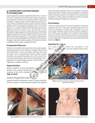 433
CHAPTER 34: Laparoscopic Hysterectomy
Figs. 3A and B: Pervaginal examination should be routine.
LAPAROSCOPIC-ASSISTED VAGINAL
HYSTERECTOMY
Laparoscopically-assisted vaginal hysterectomy is one of
the most frequently performed gynecologic operations,
and numerous authors have demonstrated its safety and
feasibility. A laparoscopic-assisted vaginal hysterectomy is
a type 3 Garry and Reich hysterectomy in which the adnexal
pedicles of the round ligament, fallopian tube, and ovarian
ligament are released abdominally through laparoscopic
approach while the uterine artery and vein are secured
throughthevaginalapproach.Furtherdissectionofthebroad
ligament anteriorly to free the bladder from the uterovesical
fold is done laparoscopically. A 2 cm posterior colpotomy in
between the uterosacral ligaments at the base of the pouch of
Douglas is also done laparoscopically. This dissection allows
completion of the surgery vaginally with ease.
Preoperative Measures
Patients are evaluated same way as that of any major surgery.
Routine preoperative tests include a complete blood count
with differential, serum electrolyte, bleeding time, and
urinalysis. More comprehensive blood studies include
thrombin time, partial thrombin time, ECG, chest X-ray,
and endometrial biopsy. Mechanical and antibiotic bowel
preparation is advised. Peglec powder 1 sachet with water a
night prior to surgery is advised.
Patient Position
Patient should be in steep Trendelenburg and lithotomy
position. One assistant should remain between the legs
of patient to do uterine manipulation whenever required
(Figs. 3A and B).
Position of Surgical Team (Fig. 4)
Surgeon stand left to the patient, camera assistant should be
left to the surgeon. Second assistant should be the opposite
side of the body of patient. One more assistant is required
between the legs to handle uterine manipulator. The patient
should ideally get general anesthesia with endotracheal
intubation. A Foley catheter should be inserted to provide
bladder drainage throughout the operation.
Port Position
A 10-mm umbilical port for camera should be along the
inferior crease. Two 5-mm ports should be placed at 5 cm
away from umbilicus on either side. Sometime, accessory
port at right or left iliac region may be required according to
need. Port position should be in accordance with baseball
diamond concept. If the left side of tube has to be operated,
one port should be in right iliac fossa and another below left
iliac fossa (Fig. 5).
Operative Technique
It is important throughout the procedure to be
able to manipulate the uterus for optimal observation.
Fig. 4: Surgical team position in laparoscopically-assisted
vaginal hysterectomy.
Fig. 5: Port position for laparoscopically-assisted vaginal hysterectomy.
A B
 