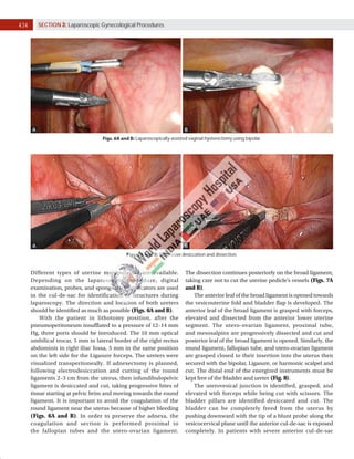 434 SECTION 3: Laparoscopic Gynecological Procedures
Figs. 6A and B: Laparoscopically-assisted vaginal hysterectomy using bipolar.
A B
Figs. 7A and B: Successive desiccation and dissection.
A B
Different types of uterine manipulators are available.
Depending on the laparoscopic procedure, digital
examination, probes, and sponge stick applicators are used
in the cul-de-sac for identification of structures during
laparoscopy. The direction and location of both ureters
should be identified as much as possible (Figs. 6A and B).
With the patient in lithotomy position, after the
pneumoperitoneum insufflated to a pressure of 12–14 mm
Hg, three ports should be introduced. The 10 mm optical
umbilical trocar, 5 mm in lateral border of the right rectus
abdominis in right iliac fossa, 5 mm in the same position
on the left side for the Ligasure forceps. The ureters were
visualized transperitoneally. If adnexectomy is planned,
following electrodesiccation and cutting of the round
ligaments 2–3 cm from the uterus, then infundibulopelvic
ligament is desiccated and cut, taking progressive bites of
tissue starting at pelvic brim and moving towards the round
ligament. It is important to avoid the coagulation of the
round ligament near the uterus because of higher bleeding
(Figs. 6A and B). In order to preserve the adnexa, the
coagulation and section is performed proximal to
the fallopian tubes and the utero-ovarian ligament.
The dissection continues posteriorly on the broad ligament,
taking care not to cut the uterine pedicle’s vessels (Figs. 7A
and B).
The anterior leaf of the broad ligament is opened towards
the vesicouterine fold and bladder flap is developed. The
anterior leaf of the broad ligament is grasped with forceps,
elevated and dissected from the anterior lower uterine
segment. The utero-ovarian ligament, proximal tube,
and mesosalpinx are progressively dissected and cut and
posterior leaf of the broad ligament is opened. Similarly, the
round ligament, fallopian tube, and utero-ovarian ligament
are grasped closed to their insertion into the uterus then
secured with the bipolar, Ligasure, or harmonic scalpel and
cut. The distal end of the energized instruments must be
kept free of the bladder and ureter (Fig. 8).
The uterovesical junction is identified, grasped, and
elevated with forceps while being cut with scissors. The
bladder pillars are identified desiccated and cut. The
bladder can be completely freed from the uterus by
pushing downward with the tip of a blunt probe along the
vesicocervical plane until the anterior cul-de-sac is exposed
completely. In patients with severe anterior cul-de-sac
 