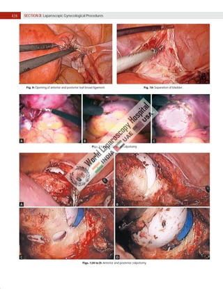 436 SECTION 3: Laparoscopic Gynecological Procedures
Fig. 9: Opening of anterior and posterior leaf broad ligament. Fig. 10: Separation of bladder.
Figs. 11A to C: Steps of colpotomy.
Figs. 12A to D: Anterior and posterior colpotomy.
A B C
A
C
B
D
 