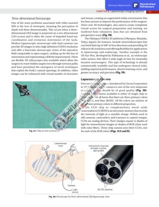 21
CHAPTER 2: Laparoscopic Imaging Systems
Fig. 28: Stereoscope for three-dimensional (3D) laparoscopic view.
and tissues, creating an augmented reality environment that
has been proven to improve the performance of the surgeon.
These new 3D technologies, also used to create completely
virtual scenes for surgical preparation and training, are
rendered from volumetric data that are obtained from
preoperative scans (Fig. 28).
The Olympus VISERA 3D platforms (Olympus, Shinjuku,
Tokyo, Japan), for instance, include stereovideoscopes that
can bend their tip of 100° in four directions and providing 3D
videosin4Kresolutionandofferingflexibilityforapplications
in laparoscopy and endoscopy. Another example is the
3D-Eye-Flex, developed by Nishiyama et al., an endoscopic
video system, that offers a wide angle of view for minimally
invasive neurosurgery. This type of technology is already
commercially available and has undergone clinical trials,
yielding improved performance, shorter learning curve, and
greater accuracy and precision (Fig. 29).
Laparoscopic Camera
First medical camera was introduced by Circon Corporation
in 1972. Laparoscopic camera is one of the very important
instruments and should be of good quality (Fig. 30).
Laparoscopic camera available is either of single chip or
three chips. We all know that there are three primary colors
[red, green, and blue (RGB)]. All the colors are mixture of
these three primary colors in different proportion.
The CCD chip or complementary metal oxide
semiconductor(CMOS)isanelectronicmemorythatrecords
the intensity of light as a variable charge. Widely used in
still cameras, camcorders, and scanners to capture images,
CCDs are analog devices. Their charges equate to shades of
light for monochrome images or shades of RGB when used
with color filters. Three-chip camera uses three CCDs, one
for each of the RGB colors (Figs. 31A and B).
Three-dimensional Stereoscope
One of the main problems associated with video-assisted
MIS is the loss of stereopsis, meaning the perception of
depth and three-dimensionality. This occurs when a three-
dimensional (3D) image is projected on a two-dimensional
(2D) screen and is often the cause of impeded hand-eye
coordination and erroneous movements of the tools.
Modern laparoscopic stereoscope with dual cameras can
provide 3D images in ultra-high definition (UHD) resolution
and offer a binocular stereoscopic vision of the operative
field comparable to open surgery, making up for the loss of
stereovision and representing a definite improvement. There
are flexible 3D videoscopes also available which allow the
surgeon to reach hidden targets even through tortuous paths
and have permitted the emergence of novel techniques
that exploit the body’s natural openings. In addition, video
images can be enhanced with virtual models of structures
Fig. 27: Chip on stick technology.
Remove Watermark Wondershare
PDFelement
 