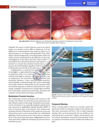 28 SECTION 1: Essentials of Laparoscopy
A B
Figs. 39A and B: Gallbladder lighting scene. (A) Poorly lit right upper quadrant. The diaphragm is barely visible;
(B) Same patient after faulty light cable is replaced.
Fig. 40: Changes in the amount of contrast in a photo, left side of the
image has low contrast and the right side of the image has higher
contrast.
Contrast: The extent to which adjacent areas of an optical
image, on a monitor screen, differ in brightness. It is the
difference in visual properties that makes an object (or its
representation in an image) distinguishable from other
objects and the background. In visual perception of the real
world, contrast is determined by the difference in the color
and brightness of the object and other objects within the
same field of view. Because the human visual system is more
sensitive to contrast than absolute luminescence, we can
perceive the world similarly regardless of the huge changes
in illumination over the day or from place-to-place (Fig. 40).
Luminescence is a general term applied to all forms
of cool light, i.e., light emitted by sources other than a hot,
incandescent body. It is a process by which an excited
material emits light in a process not caused solely by a rise
in temperature. The excitation is usually achieved with
ultraviolet radiation, X-rays, electrons, alpha particles,
electrical fields, or chemical energy. The color or wavelength
of the light emitted is determined by the material while
the intensity depends on both the material and the input
energy. Examples of luminescence include light emissions
from neon lamps, luminescent watch dials, television and
computer screens, fluorescent lamps, and fireflies.
Modulation Transfer Function
The endoscopes transmit resolution and contrast to the
monitor. The efficacy by which this occurs determines the
more delicate aspects of the image. Resolution and contrast
can be measured on an especially designed optical bench
and expressed as modulation transfer function (MTF). If
there is excessive glare in the picture, then contrast and
resolution decrease. Distortions of the image can occur and
if these lines seem to curve outward they are called barrel
distortion. Field curvature occurs when there is improper
focus of the center from other parts. Astigmatism can occur
when some lines of different orientation are present in focus
and others are not.
Temporal Aliasing
When a moving object is shown on a monitor, unless the
speed with which it is moving is similar to the refresh rate,
then jerky movements will occur. This is called temporal
aliasing. This can be prevented by the use of filters or by
performing slow movements. Fatigue and headache can
occur due to disturbance of saccadic eye movements. These
are rapid eye movements used to visualize the borders of a
field.
Remove Watermark Wondershare
PDFelement
 