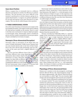 29
CHAPTER 2: Laparoscopic Imaging Systems
Gaze-down Position
When a surgeon has to constantly look in a different
direction and operate in another, his efficiency to perform
declines. The job becomes even more difficult if the
monitor is positioned at a further distance, giving rise to
spatial disorientation. A surgeon can perform optimally if
he can look and operate in the same direction as in open
surgery. This can also be called the gaze-down position.
THREE-DIMENSIONAL VISION
One of the major limitations of minimal access surgery is the
loss of depth perception. The surgeon works with an artificial
2D video pictures available on the monitor. There is a need
to develop some mechanism to improve depth perception
or stereoscopic vision. Stereoscopic vision is needed for
precise and fast complex manipulations because perception
of space and depth are necessary in surgery.
Stereopsis (Three-dimensional Perception)
Stereopsis refers to perception of 3D shape from any
source of depth information. Unlike horses, humans have
two eyes located side-by-side in the front of their heads.
Due to the close side-by-side positioning, each eye takes
a view of the same area from a slightly different angle
(Fig. 41).
The two eyes have different views of the visual world
and these different views setup disparities that give us
information about relative depth of the image that is third
dimension of vision. Binocular disparity results when
image of an object falls on different areas of the two retinas
and binocular vision or stereopsis is impression of depth
resulting from differences in the images on these two retinas.
We lose stereoscopic vision in laparoscopy because both
eyes see same 2D pictures available on the monitor.
Fig. 41: Difference in angle of light on different retinas.
Stereoscopic vision is simultaneous vision with two eyes
(binuclear vision), producing a visual experience of the
third-dimension (the depth), i.e., a vivid perception of the
relative distances of objects in space. In this experience, the
observer seems to see the space between the objects located
at different distances from the eyes (the three-dimensions
are width, length, and depth).
It is present in normal binocular vision because the two
eyes view objects in space from two points, so that the retinal
image patterns of the same object points in space are slightly
different in the two eyes. The stereoscope, with which
differentpicturescanbepresentedtoeacheye,demonstrates
thefundamentaldifferencebetweenstereoscopicperception
of depth (third-dimension) and the conception of depth and
distance from the monocular view.
Humans normally have binocular vision, i.e., separate
images of the visual field are formed by each eye; the two
images fuse to form a single impression. Because each
eye forms its own image from a slightly different angle, a
stereoscopic effect is obtained and depth, distance, and
solidity of an object are appreciated. Stereoscopic color
vision is found primarily among the higher primates and it
developed fairly late on the evolutionary scale.
Binocular Vision
It refers to vision with two eyes. In binocular vision, the
visual axes of the eyes are arranged in such a manner that the
images of the object viewed strike the identical portions of
the retinas of both eyes. This produces a single stereoscopic
image—a view of the world in relief. Binocular vision also
makes it possible to determine visually the relative location
of objects in space and to judge their distance from each
other. When looking with one eye—i.e., with monocular
vision—the distance of objects can likewise be judged, but
not as accurately as with binocular vision.
Physiology of Three-dimensional Vision
Human eye is sensitive to the electromagnetic wavelength
between 400 and 700 nm. The “electromagnetic energy” in
the range of approximately “400–700 nm”
, which the human
eye can transduce, is called “light”
. The eyes transduce light
energy in the electromagnetic spectrum into nerve impulses.
In 1838, Charles Wheatstone published the first paper
on stereopsis entitled “On some remarkable and hitherto
unobserved, phenomena of binocular vision”
. In this, he
pointed out that the positional differences in the two eye’s
images due to their horizontal separation yielded depth
information. Prior to this time, the principal problem in the
study of binocular vision was “how the world seen as single
when we have two different views of it?” People thought
that only objects with the same visual directions, falling on
corresponding points, would be seen as single, all other
points would be double by means of the stereoscope that
Remove Watermark Wondershare
PDFelement
 
