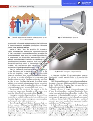30 SECTION 1: Essentials of Laparoscopy
he invented. Wheatstone demonstrated that the stimulation
of noncorresponding points yield singleness of vision and
results in the perception of depth.
Cells in visual cortex are sensitive for binocular
vision. Some cells are sensitive for corresponding areas
of the left and right retinas and some have sensation for
noncorresponding areas of the two retinas. The difference
in image on the two retinas of eye is perceived by cortex as
a depth. Binocular disparity provides the visual system with
information concerning the 3D layout of the environment.
Recent physiological studies in the primary visual cortex
provide a successful account of the mechanisms by which
single neurons are able to signal disparity.
Recent studies of visual perception have begun to
reveal the connection between neuronal activity in the
brain and conscious visual experience. Transcranial
magnetic stimulation of the human occipital lobe disrupts
the normal perception of objects in ways suggesting
that important aspects of visual perception are based on
activity in early visual cortical areas. Recordings made
with microelectrodes in animals suggest that the perception
ofthelightnessanddepthofvisualsurfacesdevelopsthrough
computations performed across multiple brain areas.
Even though the picture on the monitor is 2D, the
operator can assume some depth due to different cues form
on ocular vision. This is known as depth cue (Fig. 42).
Among the entire depth cue mentioned above, only few
monocular are available on the monitor screen. Oculomotor
binocular depth cue such as convergence, accommodation,
and stereopsis is lost in 2D monitor screen.
Even though the picture is 2D, these depth cues help our
brain to interpret a 2D image into virtual 3D feeling. Today,
the picture on the screen is 2D but our brain is continuously
converting this 2D image in 3D by the help of different
monocular depth cues. This conversion of 2D pictures into
3D pictures by brain helps the surgeon to perform a task in
laparoscopic surgery.
Fig. 42: Different depth cues: The depth cues which are crossed are lost
in minimal access surgery.
Fig. 43: Shadow telescope by Schurr.
A telescope with light delivering through a separate
illumination cannula was developed by Schurr in 1996
(Fig. 43).
With slight modification, the section for minimally inva-
sivesurgery,UniversityofTübingenandMGBEndoskopische
Geräte GmbH Berlin Company have introduced a new
shadow telescope in 1999 (Fig. 44).
Shadow telescope is a rigid 10 mm endoscope with
30° view direction and uses additional illumination fibers
ending in an optimized distance behind the front lens. This
arrangement of illumination fibers creates a more natural
and more plastic appearance, a better balanced contrast, and
a well-dosed visible shadow. The shadow gives additional
secondary space clues and, therefore, improves orientation
and judgment of the 3D properties.
In shadow telescope, angle between the first and second
source of illumination is fixed and due to this shadow is also
fixed. The second problem with this telescope is that the light
which is creating shadow comes from below, but we do not
usually experience getting illuminated from the floor. All the
light in our day-to-day life is coming from above and most of
Fig. 44: Shadow telescope of Tübingen University.
Remove Watermark Wondershare
PDFelement
 