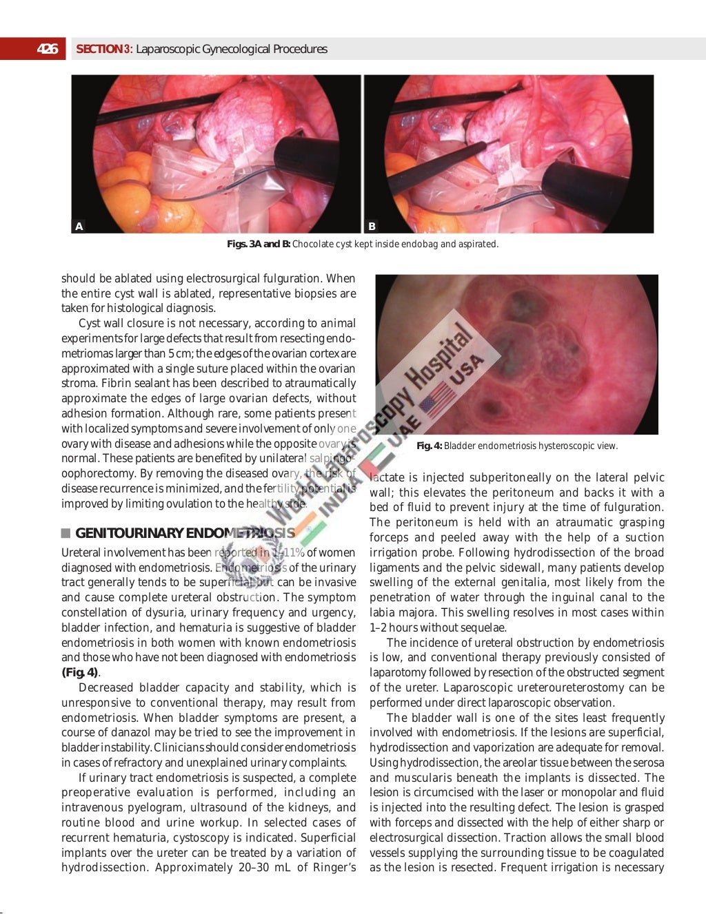 Laparoscopic Management of Endometriosis