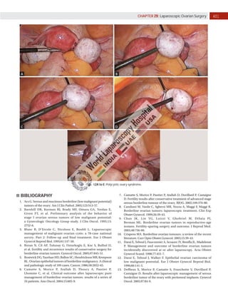 401
CHAPTER 29: Laparoscopic Ovarian Surgery
Figs. 12A to E: Polycystic ovary syndrome.
A
C
E
B
D
BIBLIOGRAPHY
1. Acs G. Serous and mucinous borderline (low malignant potential)
tumors of the ovary. Am J Clin Pathol. 2005;123:S13­57.
2. Barnhill DR, Kurman RJ, Brady MF, Omura GA, Yordan E,
Given FT, et al. Preliminary analysis of the behavior of
stage I ovarian serous tumors of low malignant potential:
a Gynecologic Oncology Group study. J Clin Oncol. 1995;13:
2752­6.
3. Blanc B, D’Ercole C, Nicoloso E, Boubli L. Laparoscopic
management of malignant ovarian cysts: a 78­case national
survey. Part 2: Follow­up and final treatment. Eur J Obstet
Gynecol Reprod Biol. 1995;61:147­50.
4. Boran N, Cil AP, Tulunay G, Ozturkoglu E, Koc S, Bulbul D,
et al. Fertility and recurrence results of conservative surgery for
borderline ovarian tumors. Gynecol Oncol. 2005;97:845­51.
5. BostwickDG,TazelaarHD,BallonSC,HendricksonMR,Kempson
RL. Ovarian epithelial tumors of borderline malignancy. A clinical
and pathologic study of 109 cases. Cancer. 1986;58:2052­65.
6. Camatte S, Morice P, Atallah D, Thoury A, Pautier P,
Lhomme C, et al. Clinical outcome after laparoscopic pure
management of borderline ovarian tumors: results of a series of
34 patients. Ann Oncol. 2004;15:605­9.
7. Camatte S, Morice P, Pautier P, Atallah D, Duvillard P, Castaigne
D. Fertility results after conservative treatment of advanced stage
serous borderline tumour of the ovary. BJOG. 2002;109:376­80.
8. Candiani M, Vasile C, Sgherzi MR, Nozza A, Maggi F, Maggi R.
Borderline ovarian tumors: laparoscopic treatment. Clin Exp
Obstet Gynecol. 1999;26:39­43.
9. Chan JK, Lin YG, Loizzi V, Ghobriel M, DiSaia PJ,
Berman ML. Borderline ovarian tumors in reproductive­age
women. Fertility­sparing surgery and outcome. J Reprod Med.
2003;48:756­60.
10. Crispens MA. Borderline ovarian tumours: a review of the recent
literature. Curr Opin Obstet Gynecol. 2003;15:39­43.
11. Darai E, Teboul J, Fauconnier A, Scoazec JY, Benifla JL, Madelenat
P. Management and outcome of borderline ovarian tumors
incidentally discovered at or after laparoscopy. Acta Obstet
Gynecol Scand. 1998;77:451­7.
12. Darai E, Teboul J, Walker F. Epithelial ovarian carcinoma of
low malignant potential. Eur J Obstet Gynecol Reprod Biol.
1996;66:141­5.
13. Deffieux X, Morice P, Camatte S, Fourchotte V, Duvillard P,
Castaigne D. Results after laparoscopic management of serous
borderline tumor of the ovary with peritoneal implants. Gynecol
Oncol. 2005;97:84­9.
 