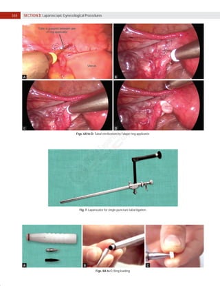 CHAPTER 44: Minimally Invasive Surgery | Obgyn Key