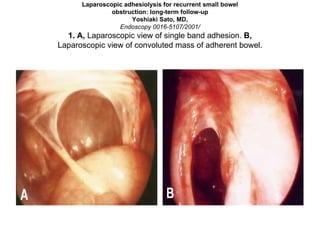 Laparoscopic adhesiolysis for recurrent small bowel obstruction: long-term follow-up Yoshiaki Sato, MD, Endoscopy 0016-5107/2001/ 1. A,  Laparoscopic view of single band adhesion.  B, Laparoscopic view of convoluted mass of adherent bowel. 