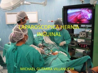 LAPAROSCOPICA HERNIA
INGUINAL
MICHAEL GUTARRA VILLANUEVA
 