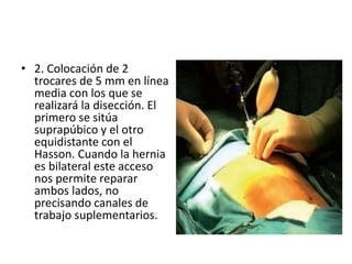 • 2. Colocación de 2
trocares de 5 mm en línea
media con los que se
realizará la disección. El
primero se sitúa
suprapúbico y el otro
equidistante con el
Hasson. Cuando la hernia
es bilateral este acceso
nos permite reparar
ambos lados, no
precisando canales de
trabajo suplementarios.
 