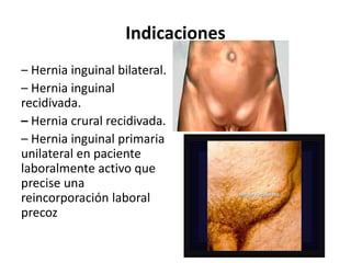 Indicaciones
– Hernia inguinal bilateral.
– Hernia inguinal
recidivada.
– Hernia crural recidivada.
– Hernia inguinal primaria
unilateral en paciente
laboralmente activo que
precise una
reincorporación laboral
precoz
 