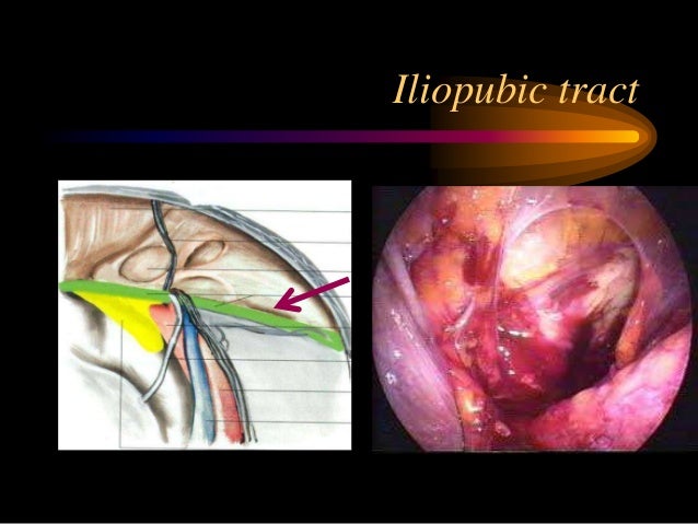Laparoscopic anatomy of inguinal canal
