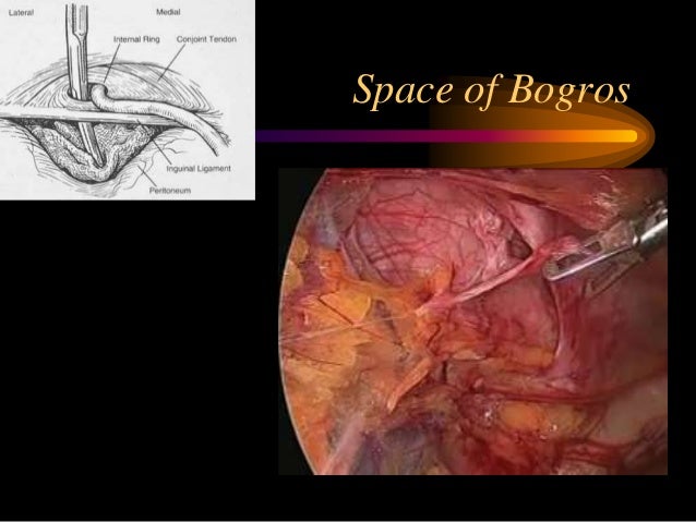Laparoscopic anatomy of inguinal canal