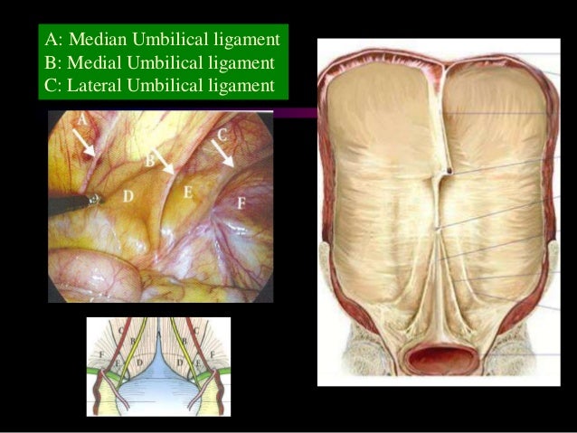Laparoscopic anatomy of inguinal canal
