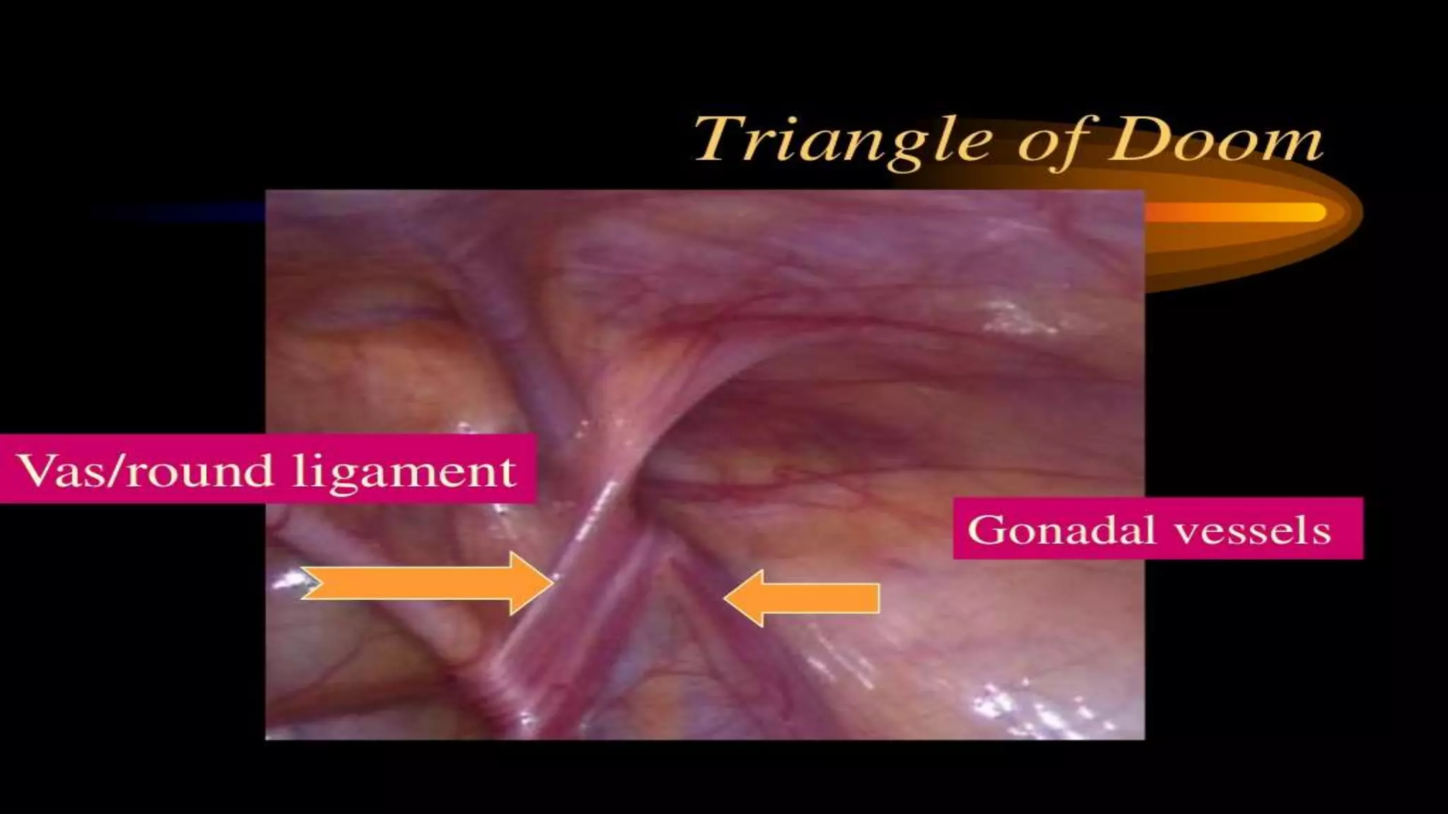 Laparoscopic Anatomy Of Inguinal Hernia PPTX